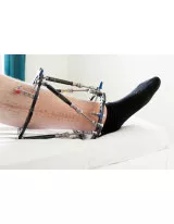 Orthopedic Trauma Devices Market in the US 2017-2021
